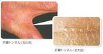 疥癬の症状　Symptom of mange3